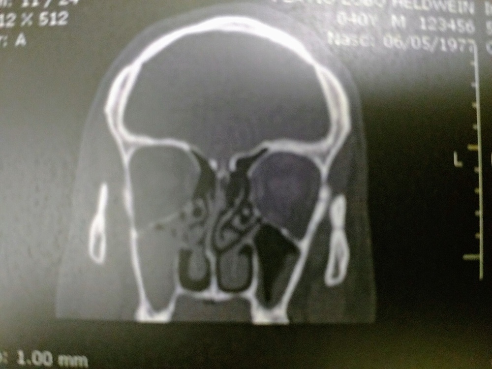 Tomografia de referência demonstrando sinusite maxilar